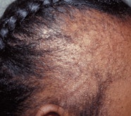 Eczema On Scalp African American