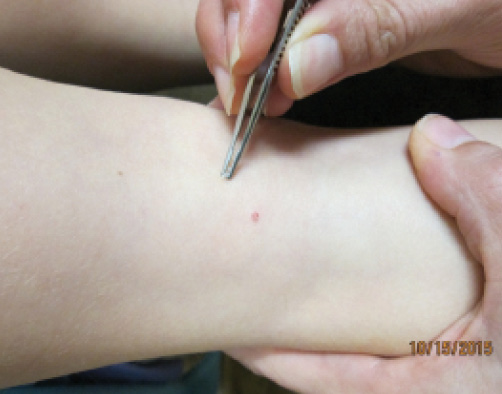 Treating Pediatric Warts and Molluscum