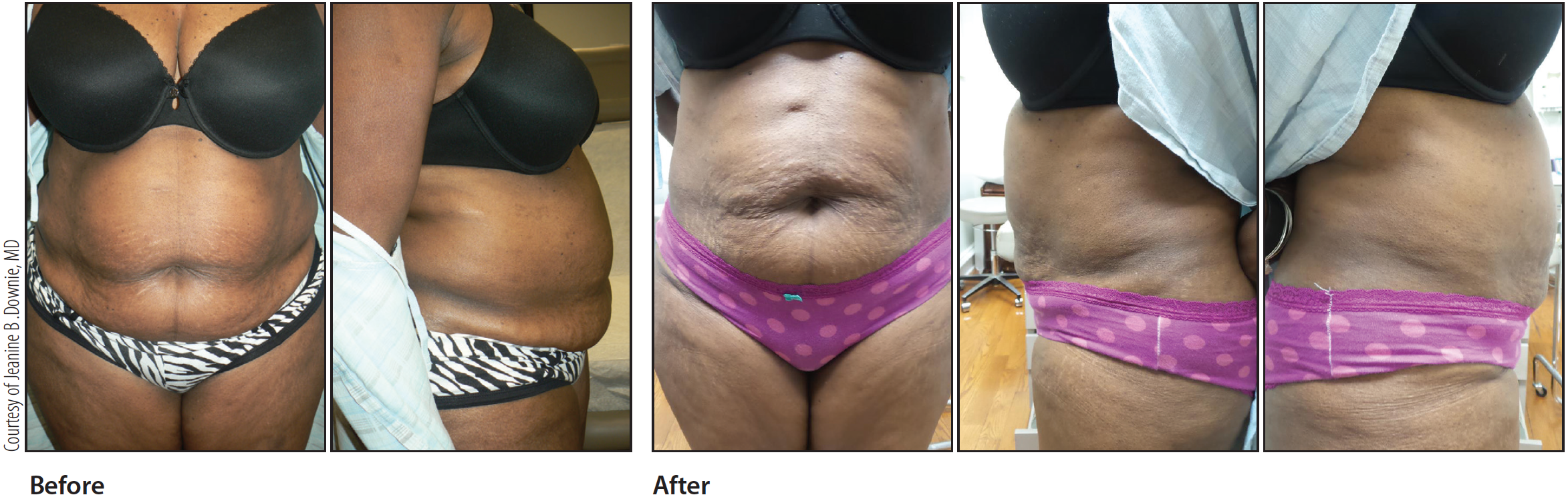 Fat Cells After Noninvasive Body Contouring Treatment