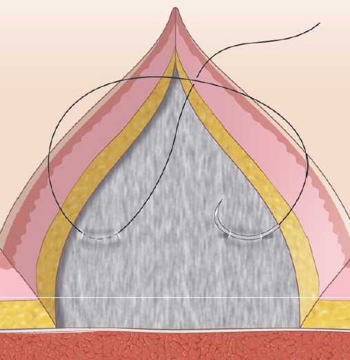 Gamechanging Suturing Techniques Practical Dermatology
