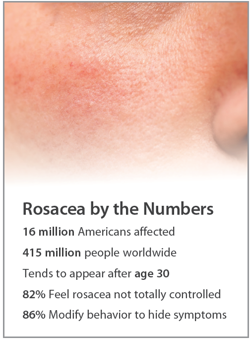 Rosacea Update: New Findings on Risks and Impact - Practical 